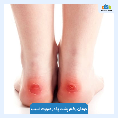 درمان زخم پشت پا در صورت آسیب