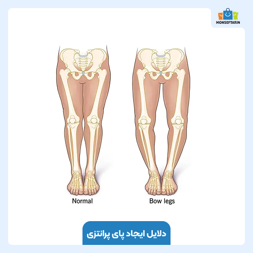 دلایل ایجاد پای پرانتزی