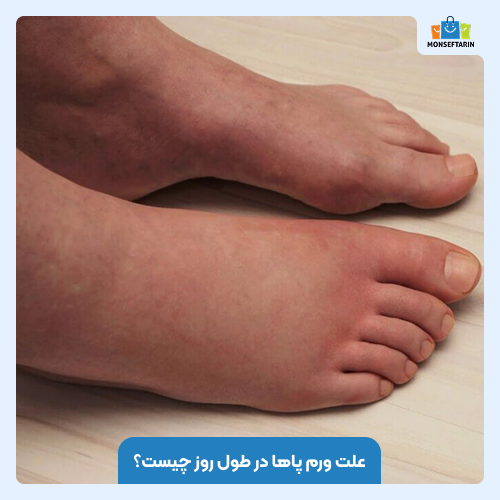 علت ورم پاها در طول روز چیست؟