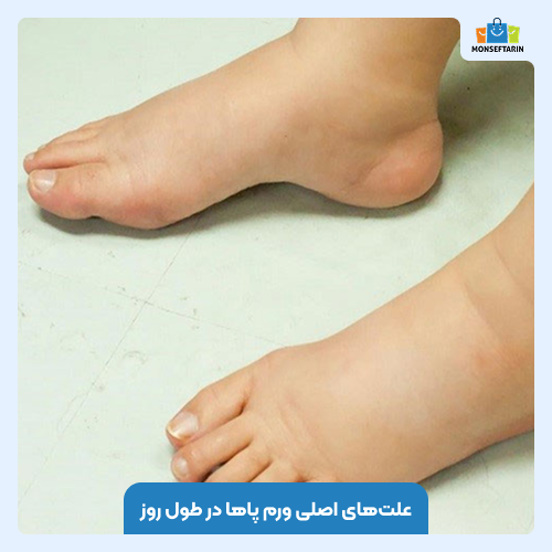 علت‌های اصلی ورم پاها در طول روز